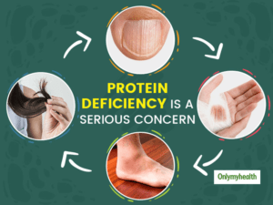 Signs of Protein Deficiency in Kids