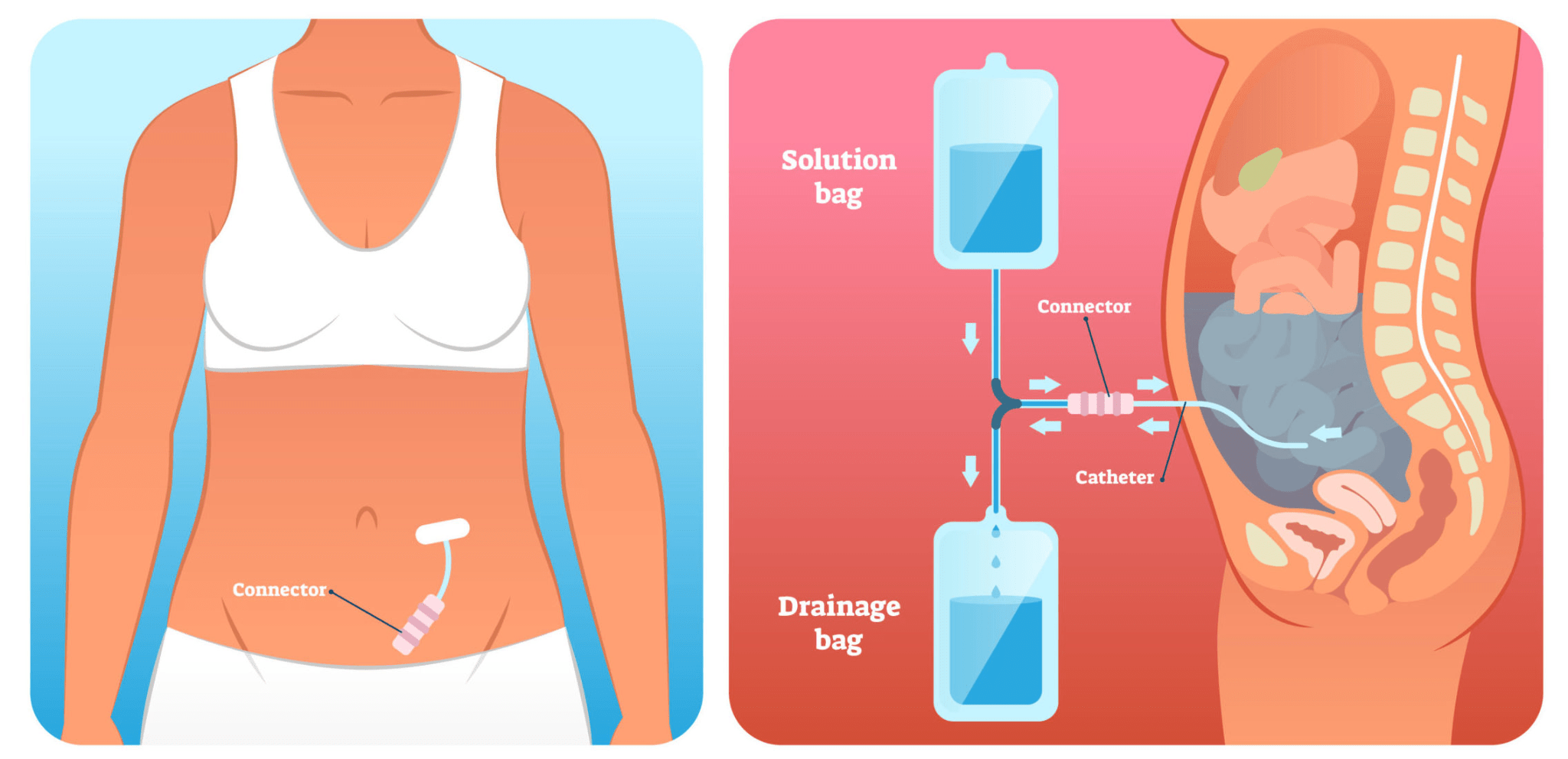 What Type of Protein Bar Can You Eat While On Dialysis? Protein Bars