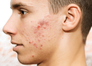 The Importance of Protein For Acne Prevention